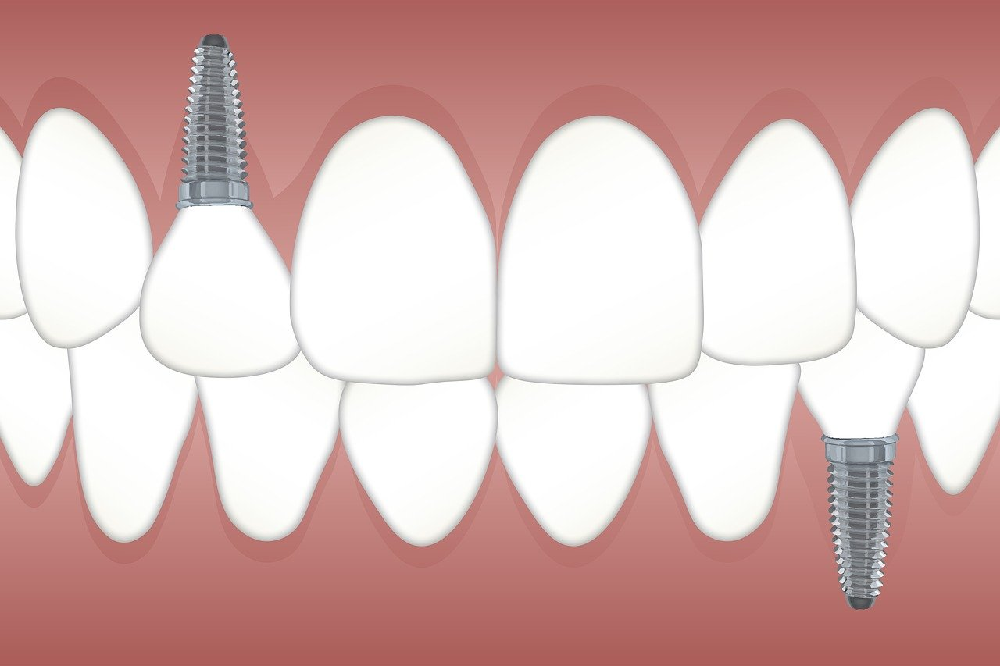 Dlaczego warto zdecydować się na implanty stomatologiczne?